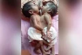 কুষ্টিয়ায় জোড়া লাগা যমজ শিশু দুটি মারা গেছে
