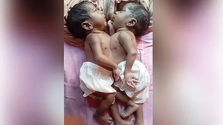 কুষ্টিয়ায় জোড়া লাগা যমজ শিশু দুটি মারা গেছে