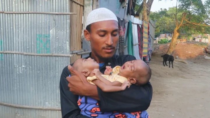 একই কবরে চিরনিদ্রায় জোড়া লাগানো শিশু